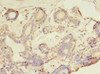 Immunohistochemistry of paraffin-embedded human breast cancer using CSB-PA665476LA01HU at dilution of 1:100
