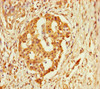 Immunohistochemistry of paraffin-embedded human pancreatic cancer using CSB-PA687502LA01HU at dilution of 1:100