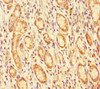 Immunohistochemistry of paraffin-embedded human gastric cancer using CSB-PA687502LA01HU at dilution of 1:100