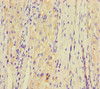 Immunohistochemistry of paraffin-embedded human liver cancer using CSB-PA727857LA01HU at dilution of 1:100