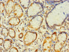 Immunohistochemistry of paraffin-embedded human gastric cancer using CSB-PA735972LA01HU at dilution of 1:100