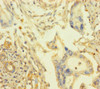 Immunohistochemistry of paraffin-embedded human pancreatic cancer using CSB-PA741070LA01HU at dilution of 1:100