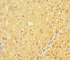 Immunohistochemistry of paraffin-embedded human liver cancer using CSB-PA745763LA01HU at dilution of 1:100 Immunohistochemistry of paraffin-embedded human liver cancer using CSB-PA745763LA01HU at dilution of 1:100