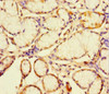 Immunohistochemistry of paraffin-embedded human gastric cancer using CSB-PA745763LA01HU at dilution of 1:100 Immunohistochemistry of paraffin-embedded human gastric cancer using CSB-PA745763LA01HU at dilution of 1:100