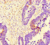 Immunohistochemistry of paraffin-embedded human ovarian cancer using CSB-PA754474LA01HU at dilution of 1:100