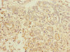 Immunohistochemistry of paraffin-embedded human pancreatic cancer using CSB-PA757502LA01HU at dilution of 1:100