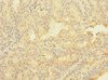 Immunohistochemistry of paraffin-embedded human endometrial cancer using CSB-PA760708LA01HU at dilution of 1:100
