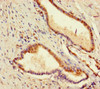 Immunohistochemistry of paraffin-embedded human prostate cancer using CSB-PA761222LA01MO at dilution of 1:100