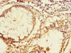 Immunohistochemistry of paraffin-embedded human colon cancer using CSB-PA765062LA01HU at dilution of 1:100