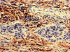 Immunohistochemistry analysis of human bladder cancer using CSB-PA765062LA01HU at dilution of 1:100