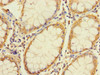 Immunohistochemistry of paraffin-embedded human colon cancer using CSB-PA773046LA01HU at dilution of 1:100