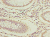 Immunohistochemistry of paraffin-embedded human colon cancer using CSB-PA773801LA01HU at dilution of 1:100