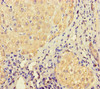 Immunohistochemistry of paraffin-embedded human liver cancer using CSB-PA774822LA01HU at dilution of 1:100 Immunohistochemistry of paraffin-embedded human liver cancer using CSB-PA774822LA01HU at dilution of 1:100
