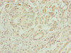 Immunohistochemistry of paraffin-embedded human pancreatic cancer using CSB-PA774834LA01HU at dilution of 1:100