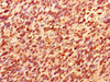 Immunohistochemistry of paraffin-embedded human glioma using CSB-PA818261LA01HU at dilution of 1:100