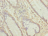 Immunohistochemistry of paraffin-embedded human colon cancer using CSB-PA819450LA01HU at dilution of 1:100