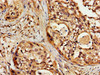 IHC image of CSB-PA823881LA01HU diluted at 1:200 and staining in paraffin-embedded human cervical cancer performed on a Leica BondTM system. After dewaxing and hydration, antigen retrieval was mediated by high pressure in a citrate buffer (pH 6.0) . Section was blocked with 10% normal goat serum 30min at RT. Then primary antibody (1% BSA) was incubated at 4°C overnight. The primary is detected by a biotinylated secondary antibody and visualized using an HRP conjugated SP system. IHC image of CSB-PA823881LA01HU diluted at 1:200 and staining in paraffin-embedded human cervical cancer performed on a Leica BondTM system. After dewaxing and hydration, antigen retrieval was mediated by high pressure in a citrate buffer (pH 6.0) . Section was blocked with 10% normal goat serum 30min at RT. Then primary antibody (1% BSA) was incubated at 4°C overnight. The primary is detected by a biotinylated secondary antibody and visualized using an HRP conjugated SP system.