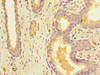 Immunohistochemistry of paraffin-embedded human prostate cancer using CSB-PA836167LA01HU at dilution of 1:100