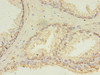 Immunohistochemistry of paraffin-embedded human prostate cancer using CSB-PA836666HA01HU at dilution of 1:100