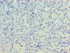 Immunohistochemistry of paraffin-embedded human breast cancer using CSB-PA836686LA01HU at dilution of 1:100