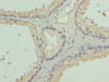 Immunohistochemistry of paraffin-embedded human prostate cancer using CSB-PA836703LA01HU at dilution of 1:100