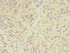 Immunohistochemistry of paraffin-embedded human liver cancer using CSB-PA838814LA01HU at dilution of 1:100