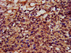 IHC image of CSB-PA839274LA01HU diluted at 1:400 and staining in paraffin-embedded human ovarian cancer performed on a Leica BondTM system. After dewaxing and hydration, antigen retrieval was mediated by high pressure in a citrate buffer (pH 6.0) . Section was blocked with 10% normal goat serum 30min at RT. Then primary antibody (1% BSA) was incubated at 4°C overnight. The primary is detected by a biotinylated secondary antibody and visualized using an HRP conjugated SP system.