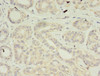 Immunohistochemistry of paraffin-embedded human breast cancer using CSB-PA839343EA01HU at dilution of 1:100