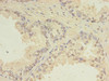 Immunohistochemistry of paraffin-embedded human prostate cancer using CSB-PA839376LA01HU at dilution of 1:100