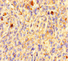 Immunohistochemistry of paraffin-embedded human melanoma using CSB-PA839894LA01HU at dilution of 1:100