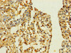 Immunohistochemistry of paraffin-embedded human bladder cancer using CSB-PA840561LA01HU at dilution of 1:100