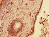 Immunohistochemistry of paraffin-embedded human prostate cancer using CSB-PA840583LA01HU at dilution of 1:100