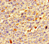 Immunohistochemistry of paraffin-embedded human melanoma using CSB-PA840974LA01HU at dilution of 1:100