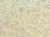 Immunohistochemistry of paraffin-embedded human liver cancer using CSB-PA840978LA01HU at dilution of 1:100