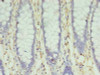Immunohistochemistry of paraffin-embedded human colon cancer using CSB-PA840985LA01HU at dilution of 1:100