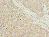 Immunohistochemistry of paraffin-embedded human ovarian cancer using CSB-PA840995LA01HU at dilution of 1:100