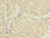 Immunohistochemistry of paraffin-embedded human gastric cancer using CSB-PA842631LA01HU at dilution of 1:100