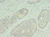 Immunohistochemistry of paraffin-embedded human gastric cancer using CSB-PA842727LA01HU at dilution of 1:100