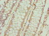 Immunohistochemistry of paraffin-embedded human colon cancer using CSB-PA843306LA01HU at dilution of 1:100