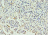 Immunohistochemistry of paraffin-embedded human lung cancer using CSB-PA843319LA01HU at dilution of 1:100