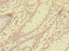 Immunohistochemistry of paraffin-embedded human colon cancer using CSB-PA844705LA01HU at dilution of 1:100