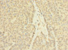 Immunohistochemistry of paraffin-embedded human ovarian cancer using CSB-PA845159LA01HU at dilution of 1:100