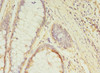 Immunohistochemistry of paraffin-embedded human colon cancer using CSB-PA846598LA01HU at dilution of 1:100