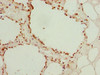 Immunohistochemistry of paraffin-embedded human breast cancer using CSB-PA846606LA01HU at dilution of 1:100