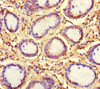 Immunohistochemistry of paraffin-embedded human gastric cancer using CSB-PA846610LA01HU at dilution of 1:100