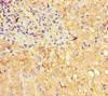 Immunohistochemistry of paraffin-embedded human liver cancer using CSB-PA846684LA01HU at dilution of 1:100