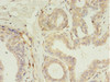 Immunohistochemistry of paraffin-embedded human breast cancer using CSB-PA850254LA01HU at dilution of 1:100 Immunohistochemistry of paraffin-embedded human breast cancer using CSB-PA850254LA01HU at dilution of 1:100