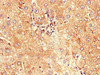 Immunohistochemistry of paraffin-embedded human liver cancer using CSB-PA850816LA01HU at dilution of 1:100