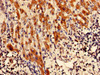 Immunohistochemistry analysis of human liver cancer using CSB-PA850915LA01HU at dilution of 1:100