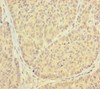 Immunohistochemistry of paraffin-embedded human ovarian cancer using CSB-PA852882HA01HU at dilution of 1:100